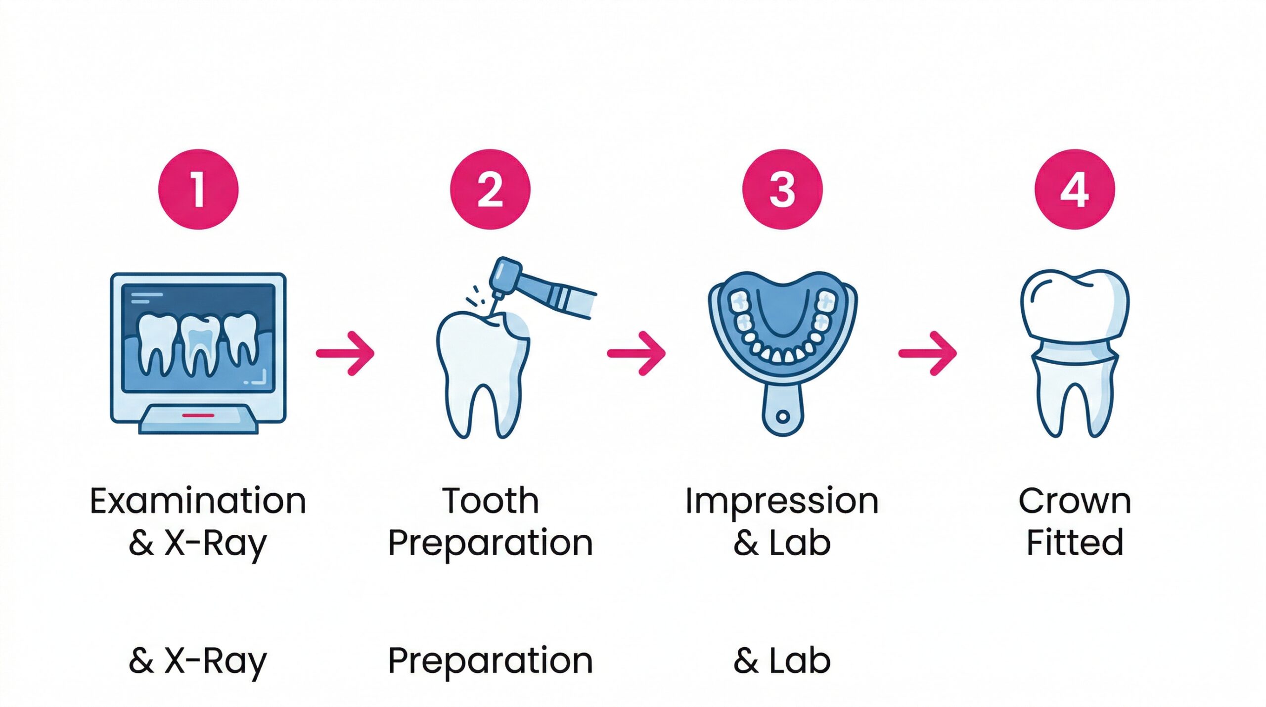 Step by step infographic showing the dental crown placement process at Gums and Giggles Kathmandu
